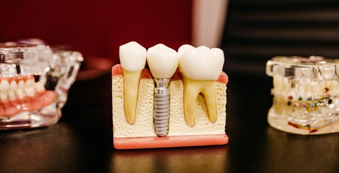 Dental Implant Model