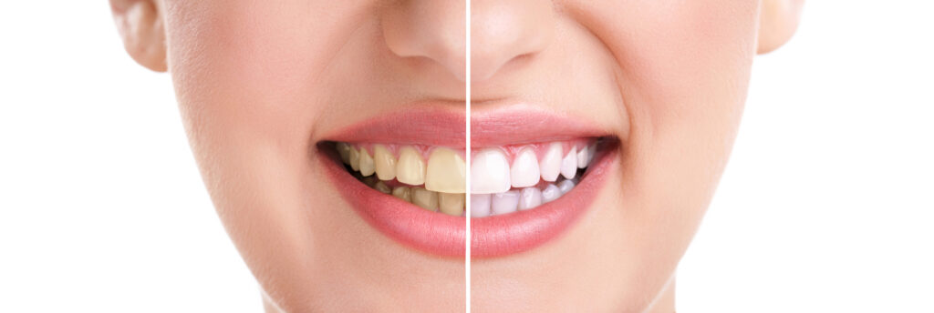 professional-teeth-whitening-magna-utah