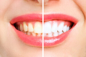 professional-teeth-whitening