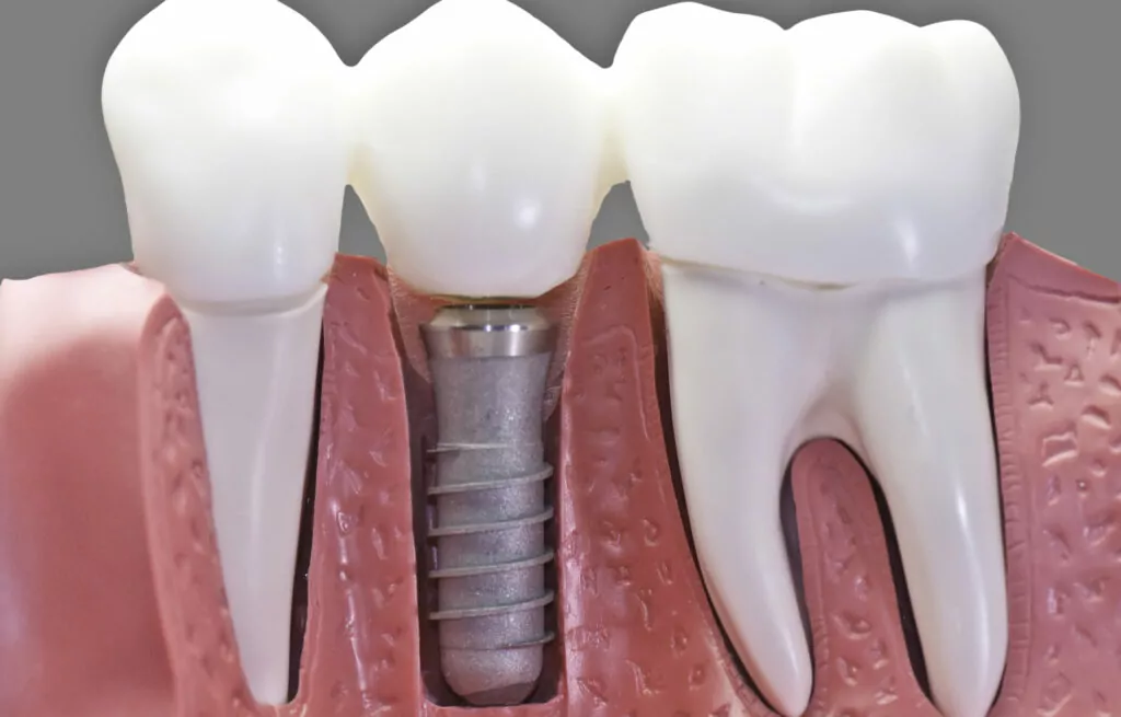Dental Implants In Magna Cyprus Family Dental