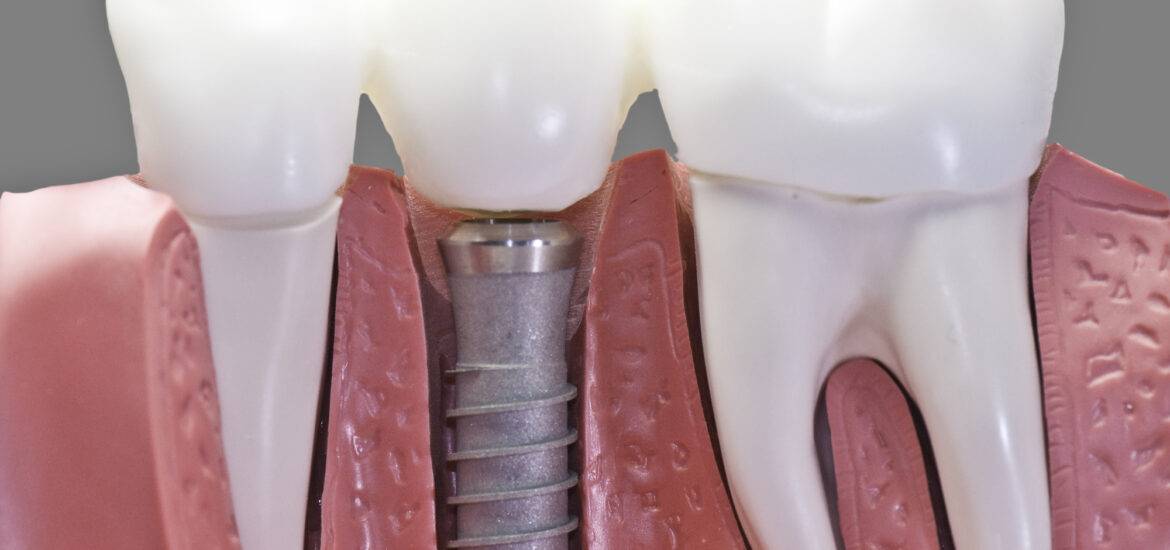 dental implants