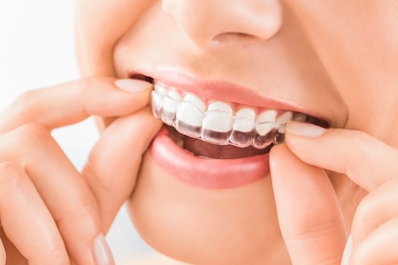 invisalign